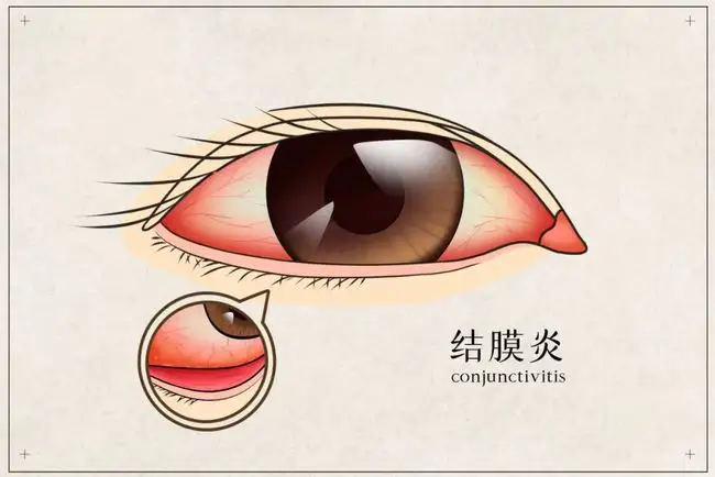 皮膚癢、拉肚子、腸胃不適、感冒，春夏換季病，艾灸來搞定！